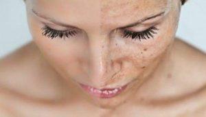 pomanjkanje kolagena